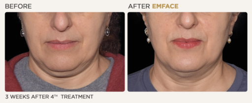 female lower face.png